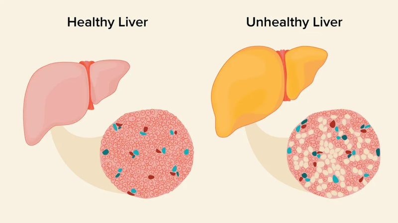 A Holistic Approach: Ayurvedic Solutions for Fatty Liver Treatment