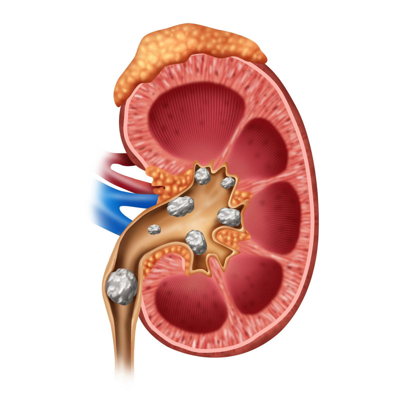 Breaking It Down: Understanding the Surging Prevalence of Kidney Stones Today