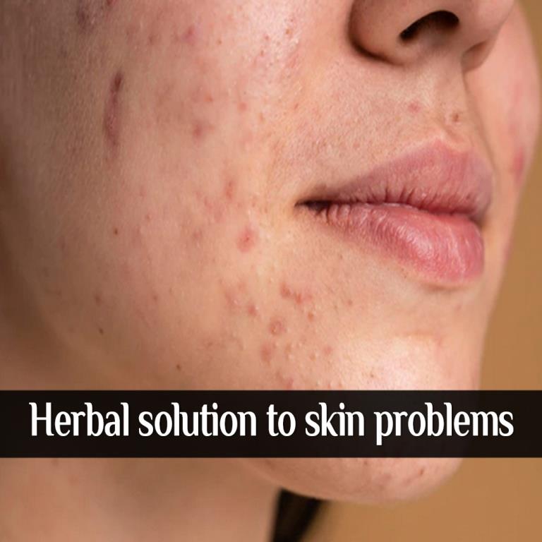 Eczema Ayurvedic Treatment Ayurvedayogashram